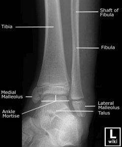Mortise view of the pediatric ankle with labeled anatomy. 