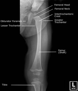 peds femur 1