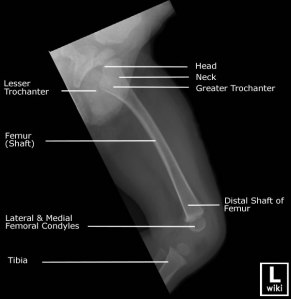 peds femur 2