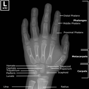 Frontal radiograph of the hand with labeled anatomy.