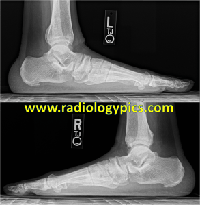 Pes Planus - Lateral radiographs of both feet show marked flattening of the longitudinal arch and overlap of the metatarsals, compatible with pes planus and pronation/valgus of the forefoot.