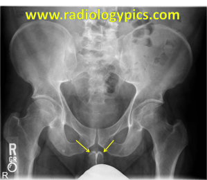 Pyeronie's Disease: Frontal radiograph of the pelvis reveals fibrosis of the bilateral corpora cavernosa covering called the tunica albuginea compatible with Peyronie's disease.