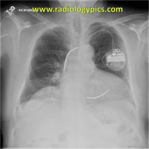 Implantable Cardioverter Defibrillator Device - frontal radiograph of the chest shows a relatively normal appearing ICD in the left chest wall with apparently intact leads in the right atrial appendage and right ventricle. 
