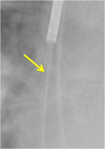 Insulation failure - zoomed in image of the above chest radiograph reveals a thin wire has broken through its insulation (yellow arrow). Note the adjacent wire to the patient's left is intact and normally surrounded by insulation. 