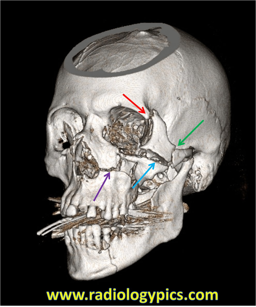 Zygomaticomaxillary Complex Fracture – AKA Tripod&nbsp;Fracture