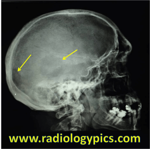 Lytic Bone Metastases - Lateral radiograph of the skull reveals two lytic lesions (yellow arrows), concerning for metastases. 