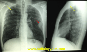Lung Cancer - Frontal and lateral radiographs of the chest reveal a spiculated mass within the right upper lobe of the lung (yellow arrow). On the contralateral side, there is a soft tissue mass within a rib (red arrow), concerning for metastasis. 