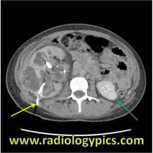Xanthogranulomatous Pyelonephritis - Axial CT of the abdomen at the level of the kidneys shows a right sided percutaneous nephrostomy tube (yellow arrow) which has been placed to drain the chronically obstructed right kidney. The normal left kidney is indicated by the green arrow.