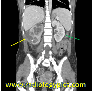 Xanthogranulomatous Pyelonephritis - Coronal CT of the abdomen and pelvis with intravenous contrast reveals right sided hydronephrosis, cortical thinning, and delayed enhancement. There is extension of the inflammatory process through the perirenal space to the adjacent abdominal wall (yellow arrow). The normal kidney is indicated by the green arrow.