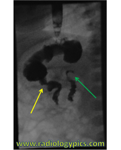 Normal Upper GI - Lateral image of the upper gastrointestinal tract in a neonate. Contrast opacifies the esophagus, stomach, and duodenum. The normal pylorus is labeled with yellow arrow, and the ligament of Treitz is indicated in green. 