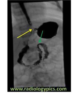 Normal Upper GI: Single spot fluoroscopic image of the upper gastrointestinal tract. Contrast is seen opacifying a normal esophagus and the gastroesophageal junction is normally located (yellow arrow). The duodenal C-Loop is normal and the ligament of Treitz is in a normal location (green arrow). 