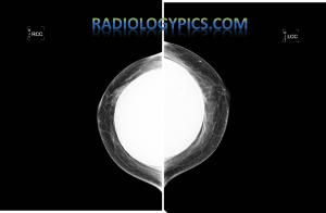 Bilateral craniocaudal (CC) views of the female breast with implants.