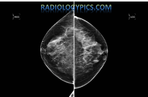 Bilateral craniocaudal (CC) views of the normal female breasts, with heterogeneously dense fibroglandular tissues (normal breast tissue).