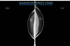 Bilateral craniocaudal (CC) views of the male breast (same patient as above MLO views), with a BB marker on the left breast indicating benign gynecomastia.