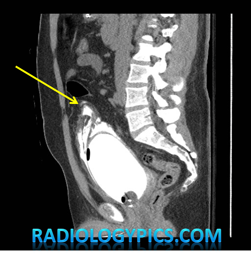 Extraperitoneal Bladder Rupture