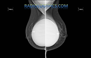 Bilateral mediolateral oblique (MLO) views of the female breast with saline implants. In both implants, a valve is noted, indicating that is saline containing, as opposed to silicone.