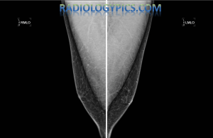 Bilateral mediolateral oblique (MLO) images of the male breast, with a BB marker (round white dot) on the left breast, indicating an area of benign gynecomastia.
