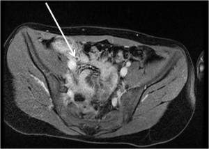 Axial post-contrast LAVA-Flex MRI demonstrates abnormal enhancement of the wall of the appendix (white arrow)