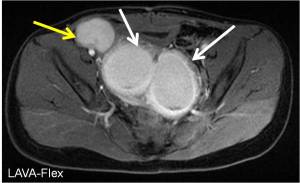 Axial LAVA Flex MRI demonstrates a fluid filled bilobed structure within the pelvis (white arrows) and additional fluid filled structure in the right inguinal region (yellow arrow). The white arrows indicate a bicornuate uterus and the yellow arrow indicates the right fallopian tube, filled with fluid.
