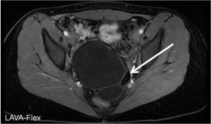 Axial LAVA-Flex MRI demonstrates a pelvic cystic structure containing fat (white arrow) as indicated by the signal corresponding to that of the subcutaneous fat 