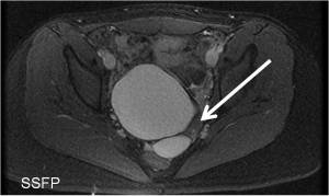 Axial FIESTA demonstrates a pelvic cystic structure containing fat (white arrow) as indicated by the signal corresponding to that of the subcutaneous fat 