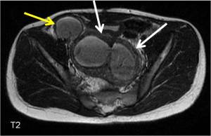 Axial T2-weighted MRI demonstrates a fluid filled bilobed structure within the pelvis (white arrows) and additional fluid filled structure in the right inguinal region (yellow arrow). The white arrows indicate a bicornuate uterus and the yellow arrow indicates the right fallopian tube, filled with fluid.