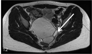 Axial T2W MRI demonstrates a pelvic cystic structure containing fat (white arrow) as indicated by the signal corresponding to that of the subcutaneous fat 