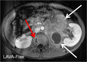 Axial LAVA-Flex MRI demonstrates a large mass  medial to the left kidney (white arrows) which displaces but does not invade the kidney. In the adjacent vertebral body there is a rim enhancing mass (red arrow) concerning for bone metastasis. 