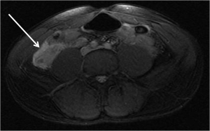 Axial FIESTA MRI demonstrates a dilated fluid filled appendix with periappendiceal fluid indicating likely perforation