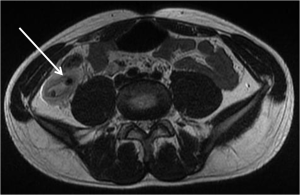 Axial T2-Weighted MRI demonstrates a dilated fluid filled appendix with periappendiceal fat stranding and two appendicoliths (dark signal within the appendix lumen)