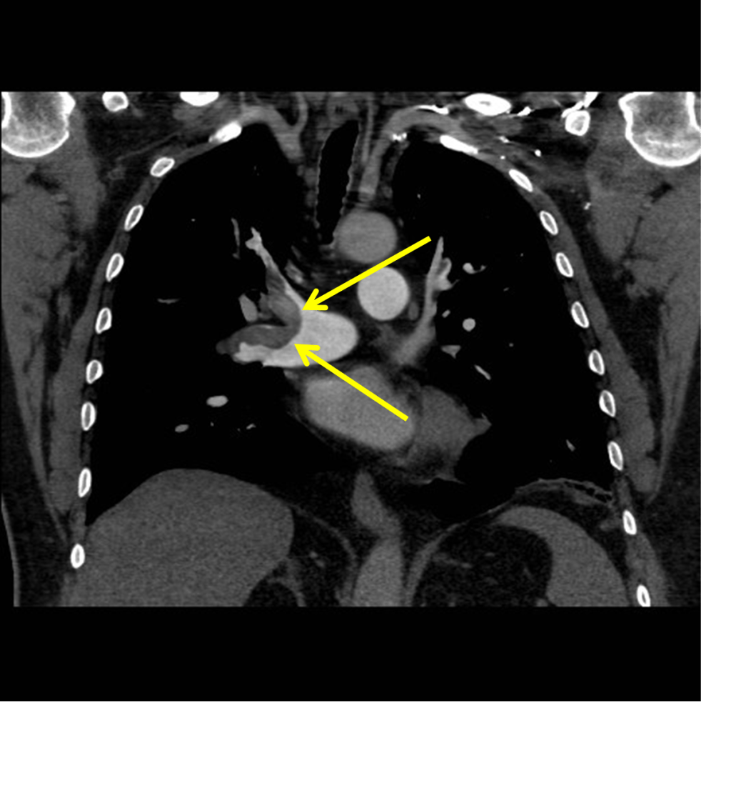 Acute Pulmonary Embolism