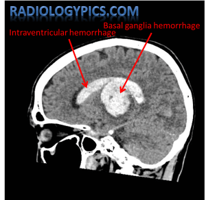 Labeled sagittal noncontrast CT of the head showing basal ganglia intraparenchymal hemorrhage extending into the lateral ventricle
