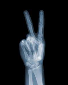 Peace Sign X Ray