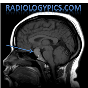Sagittal T1-weighted MRI of the brain demonstrates a lobulated sellar and suprasellar mass (blue arrow) which is homogeneously T1 hyperintense. The optic chiasm appears to be draping over this lesion. 