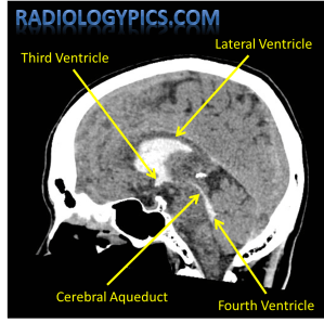 Labeled sagittal noncontrast CT scan of the head showing the ventricular system which is filled with intraventricular hemorrhage