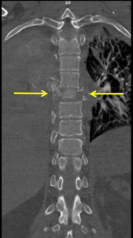 Thoracic Spine Burst Fracture