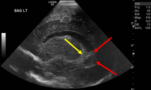 Intraventricular Hemorrhage - sagittal ultrasound of the head demonstrates hyperechoic material layering dependently within the left lateral ventricle (red arrow), representing blood clot. The normal choroid plexus is identified by the yellow arrow. 