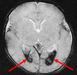 Intraventricular hemorrhage- axial gradient recalled echo image of the brain demonstrates susceptibility within the ventricles bilaterally (red arrows), compatible with layering intraventricular blood. 