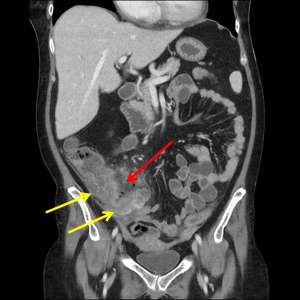 Perforated typhlitis - Coronal contrast enhanced CT of the abdomen and pelvis demonstrates marked cecal wall thickening (yellow arrows) and a focal defect in the wall of the cecum (red arrow) as well as extraluminal gas and fluid. 