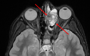 Sinonasal Osteosarcoma - Axial STIR (short tau inversion recovery) sequence through the face demonstrates a lobulated hyperintense mas in the left ethmoid sinus with multiple blood-fluid levels. 