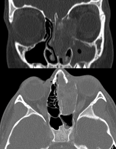 Sinonasal osteosarcoma - Coronal and axial CT scan of the face demonstrates a large expansile mass in the left ethmoid sinus with erosion into the left cribiform plate and left lamina papyracea. 