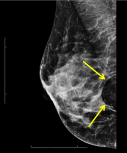 Breast Lipoma: mediolateral oblique (MLO) image of the right breast demonstrates a fat containing circumscribed oval mass in the posterior breast compatible with a breast lipoma, BIRADS category 2, benign. 