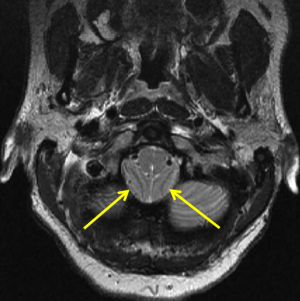 Chiari 1 malformation: Axial T2WI at the foramen magnum demonstrates ectopia of the cerebellar tonsils (yellow arrows) and effacement of the subarachnoid space.