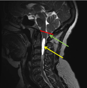 Chiari 1 malformation: Sagittal T2-weighted image at the foramen magnum demonstrates descent of the tip of the cerebellar tonsils (green arrow) below a line between the basion and the opisthion (red line). A cervical syrinx is also noted (yellow arrow).
