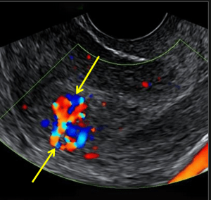 Retained products of conception: sagittal transvaginal ultrasound of the uterus with color Doppler demonstrates feeding vessels extending into the retained placental tissues (yellow arrows). 